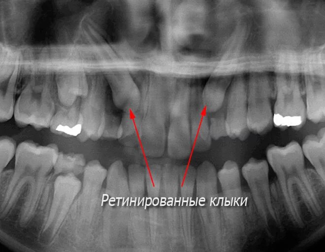 Клык фото зуба. Ретинированный клык рентген. Ретинированный дистопированный зуб мудрости. Зуб мудрости снимок ретинированный. Ретинированный зуб мудрости рентген.