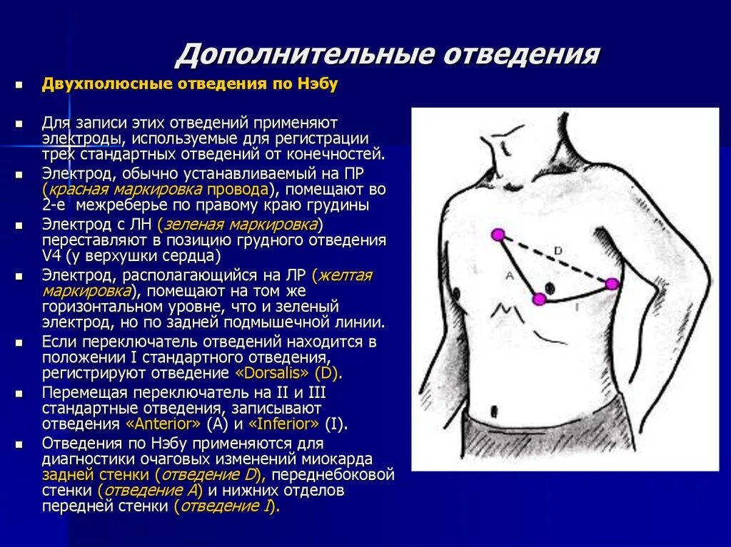 Наложение электродов v7-v9. Методика отведения в ЭКГ. Электроды v7 v8 v9. Дополнительные электроды на ЭКГ. Соп экг