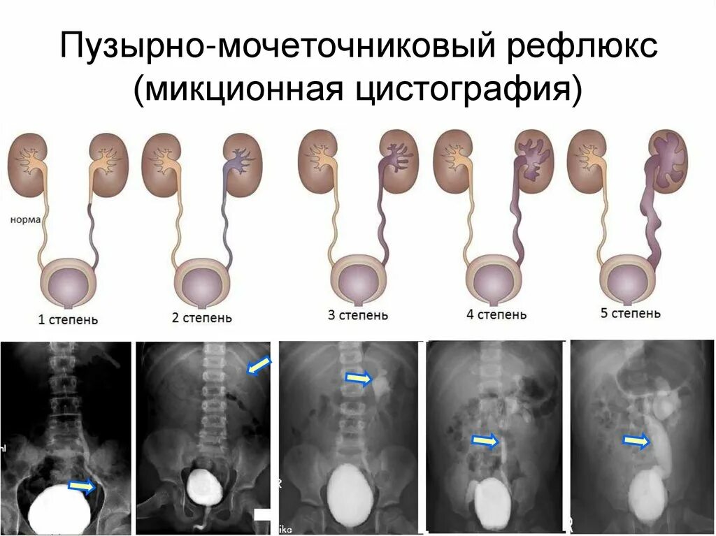 Рефлюкс у ребенка форум. Пузырно-мочеточниковый рефлюкс степени. степени пузырно-мочеточникового рефлюкса рентген. пузырно-мочеточниковый рефлюкс симптомы. пузырно-мочеточниковый рефлюкс по стадиям.