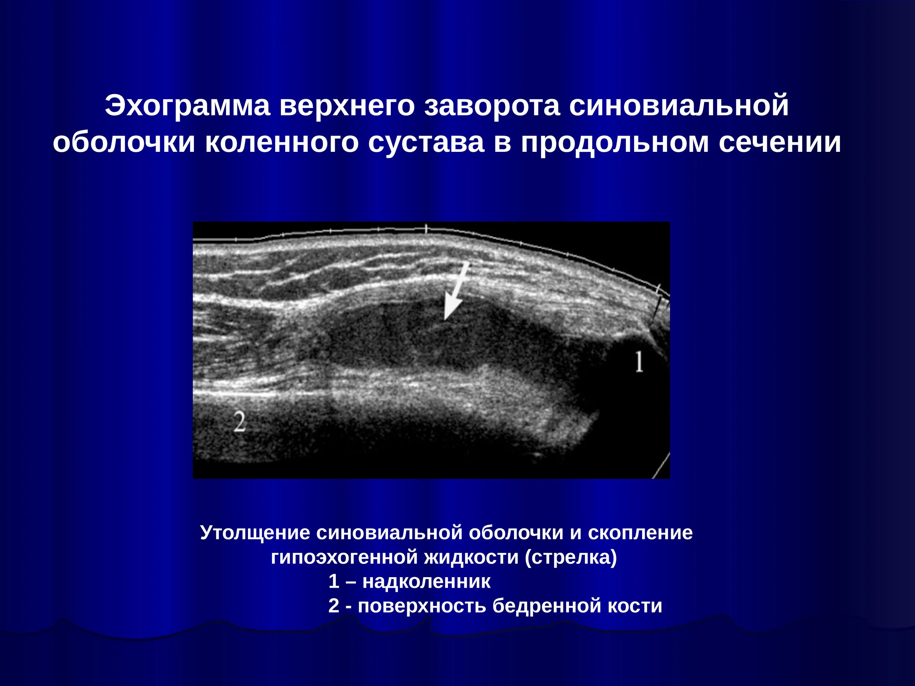 Выпот в полости коленного сустава. Синовиальная оболочка норма УЗИ. Синовиальная оболочка коленного сустава на УЗИ. Утолщение синовиальной оболочки коленного сустава на УЗИ. Жидкость в коленном суставе по УЗИ.