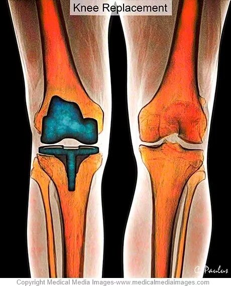 Можно ли мрт после эндопротезирования коленного сустава. Эндопротез тазобедренный stryker v40tm. Можно ли мрт после эндопротезирования коленного сустава. Можно ли мрт после эндопротезирования коленного сустава. Можно ли мрт после эндопротезирования коленного сустава.