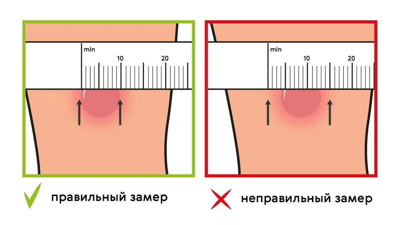 Как правильно прививка манту. Реакция манту норма у детей 8 лет норма. Прививка диаскинтест норма.