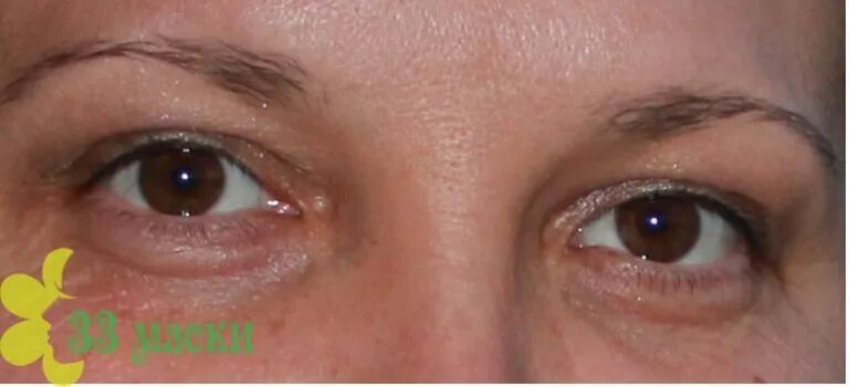 Отекшие глаза причины и лечение у женщин. Под глазом образовался мешок что это.