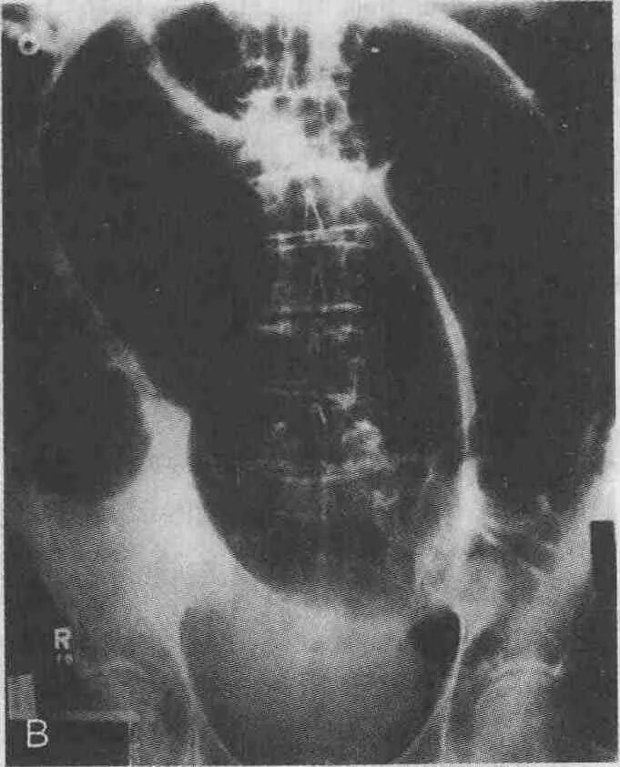 Заворот слепой кишки рентген. Заворот толстой кишки рентген. Заворот сигмовидной кишки рентген. Расширение петель кишечника