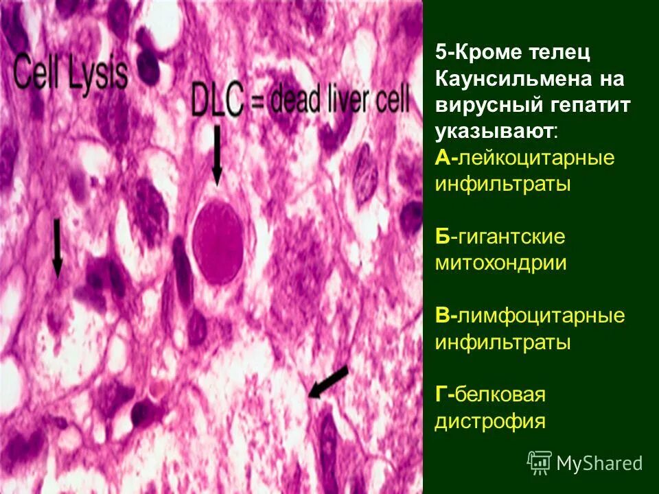 инфильтрат осложнения желчный пузырь. тельца каунсильмена микропрепарат. калькулезный холецистит узи. жировой стеатох на узи. инфильтрация желчного пузыря.