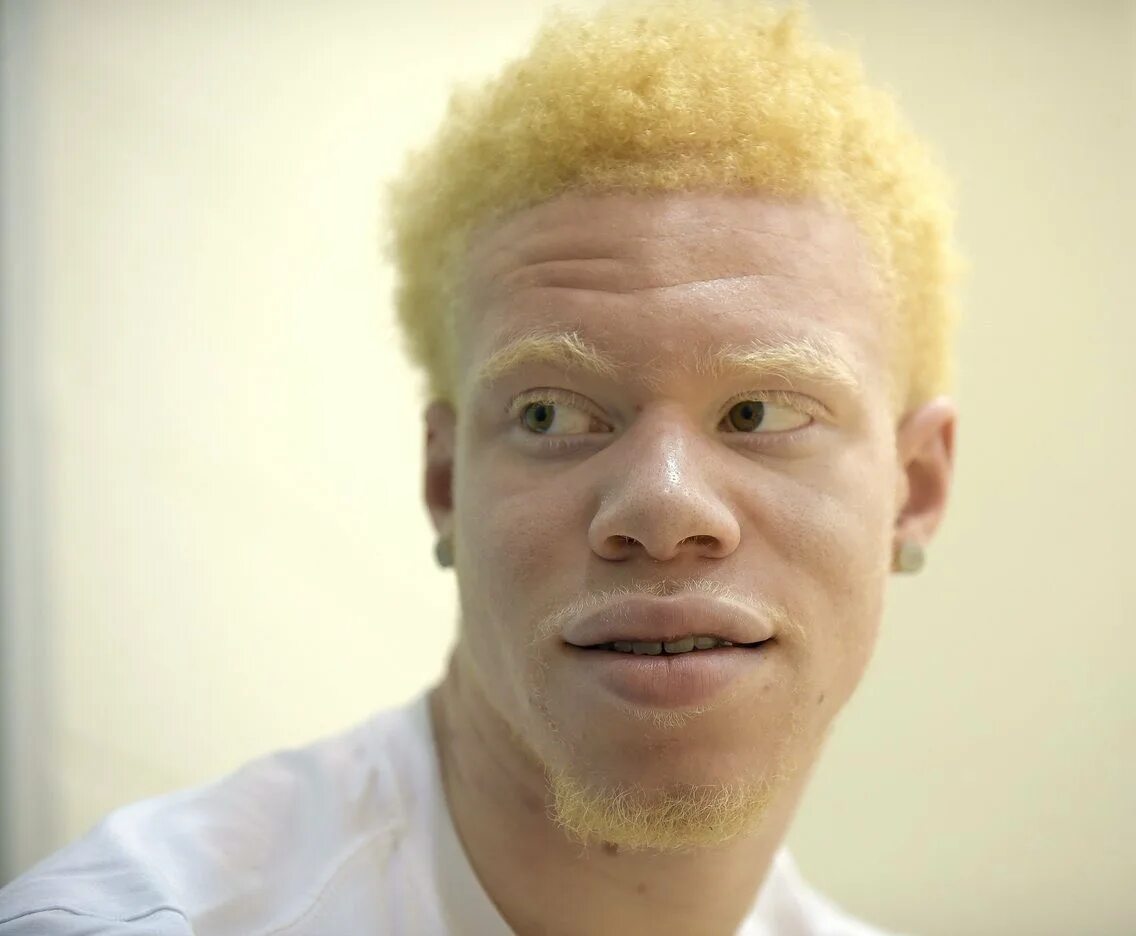 Белый негр. Афроамериканец альбинос. Альбинос негроидной расы. Афроазиат альбинос.
