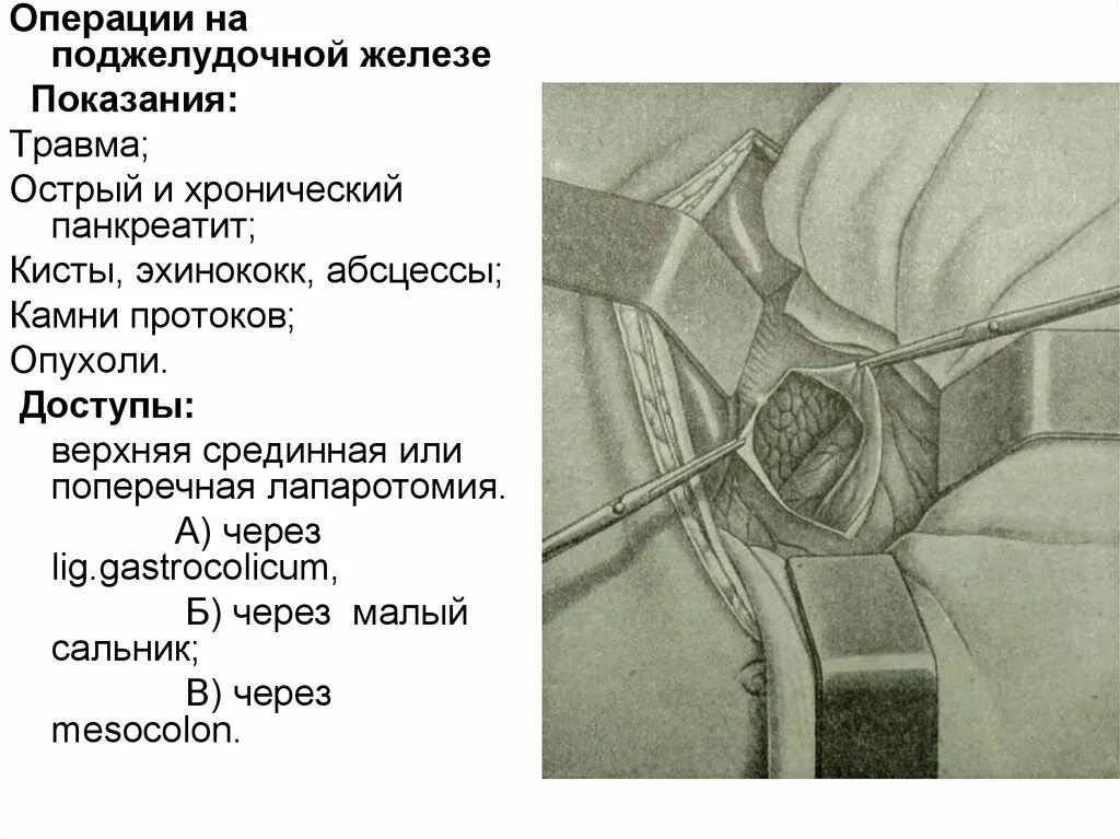 Делают ли операцию на поджелудочную. Операции на поджелудочной железе при остром панкреатите. Капсулотомия поджелудочной железы. Операция на поджелудочной железе при панкреатите ход операции. Операции при остром панкреатите топографическая анатомия.