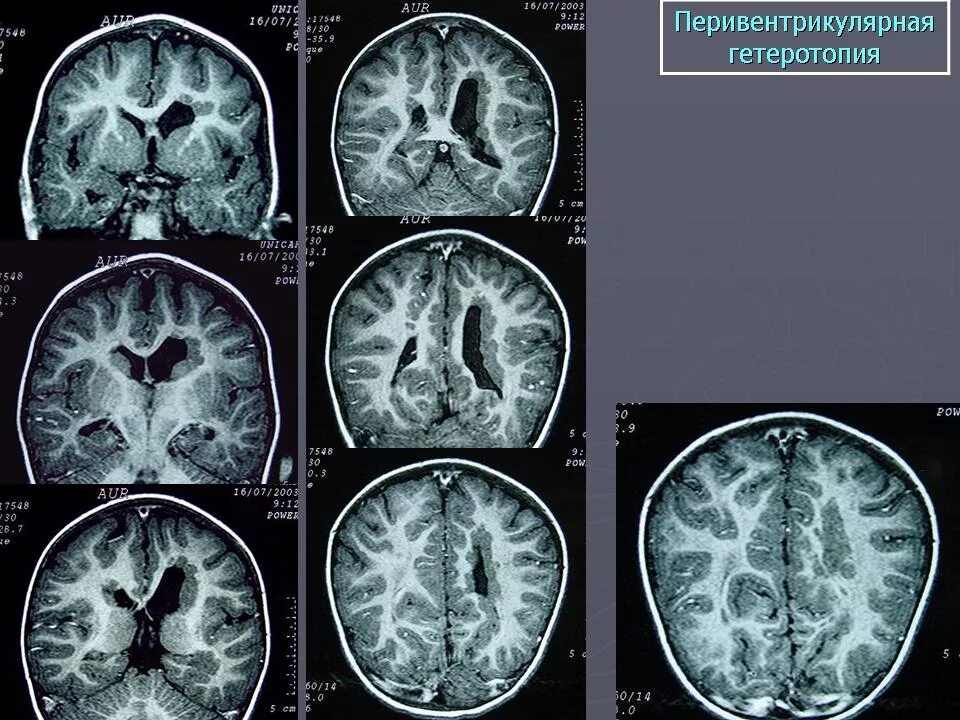 Узловая гетеротопия. Перивентрикулярная гетеротопия мрт. Перивентрикулярная гетеротопия мрт. Субэпендимальная гетеротопия. Гетеротопия головного мозга.