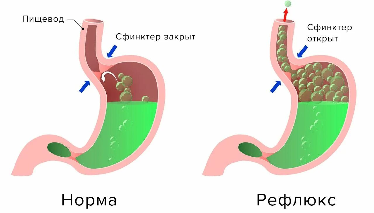 Плохой пищевод