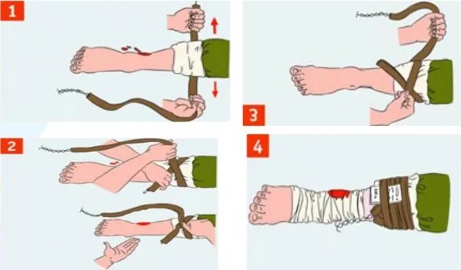 Сколько держать артериальный жгут. Правила наложения жгута при артериальном кровотечении. Наложение артериального жгута при артериальном кровотечении. Правильно наложить жгут при артериальном кровотечении. Алгоритм первой помощи при артериальном кровотечении из предплечья.