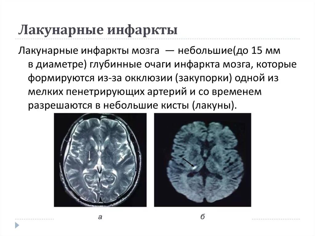 Инфаркт мозга неуточненный. Лакунарный ОНМК мрт. Лакунарный ишемический инсульт. Лакунарный ишемический инфаркт. Лакунарный инфаркт головного мозга мрт.