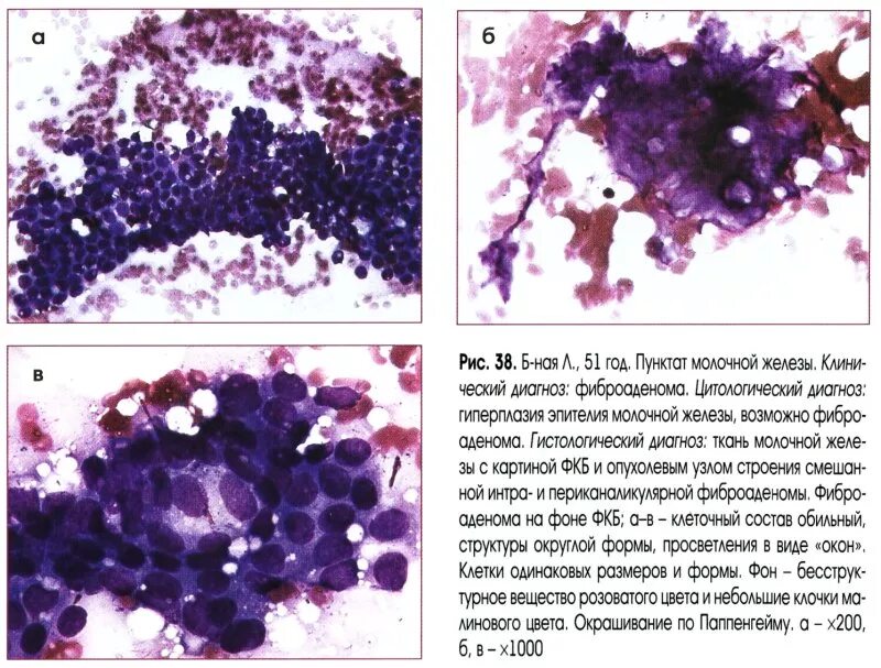Цитологическое исследование пунктата. Цитологическое исследование пунктатов молочной железы. Цитологическое исследование пунктата опухоли молочной железы. Цитологическое исследование кисты молочной железы. Цитологическое исследование мазков-отпечатков молочной железы.