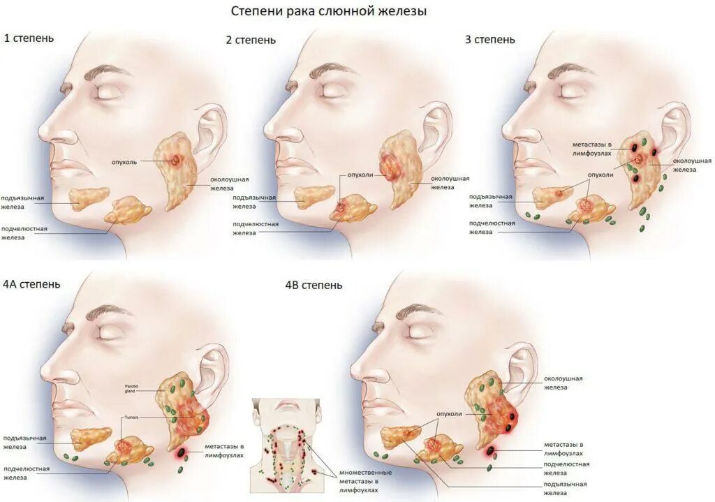 Околоушная слюнная железа опухла. Опухоль протока околоушной слюнной железы. Злокачественное новообразование околоушных слюнных желез. Шишка в околоушной слюнной железы. Увеличение околоушной железы