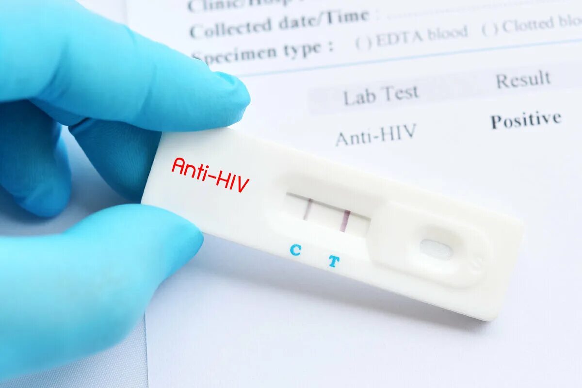 Тест на вирусную инфекцию. Тест-полоски на вич iscreen-hiv (1&amp;2). экспресс тест на вич положительный. тест на вич результат отрицательный. положительный тест на вич экспресс тест.
