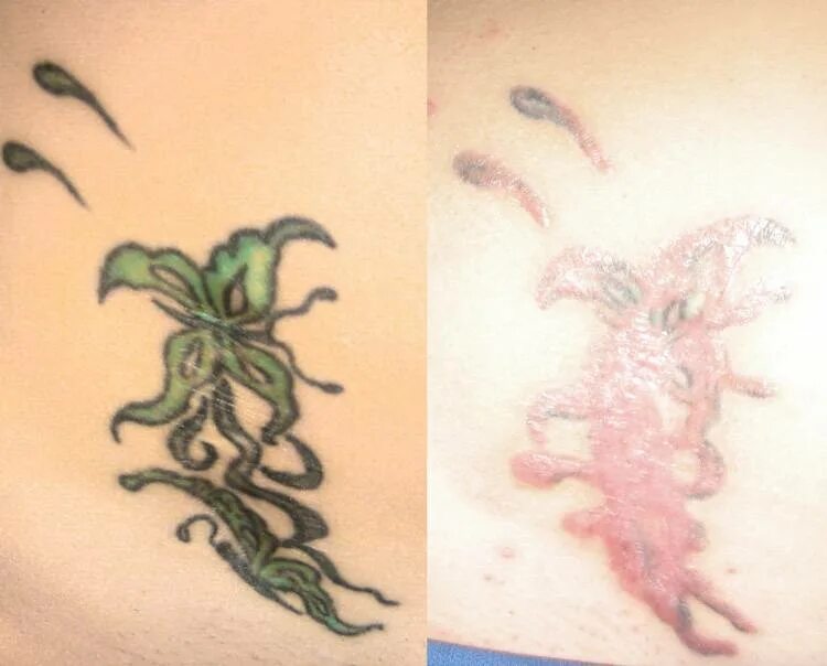 Что будет после татуировок. Осложнения после татуировки. Что будет после татуировок. Заживление татуировки. Перекрытие шрамов татуировкой.