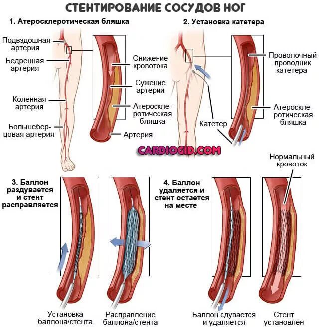 Баллонная ангиопластика бедренной артерии. Облитерирующий атеросклероз вен нижних конечностей. Стентирование подвздошной артерии. Баллонная ангиопластика артерий голени. Операция шунтирование ног