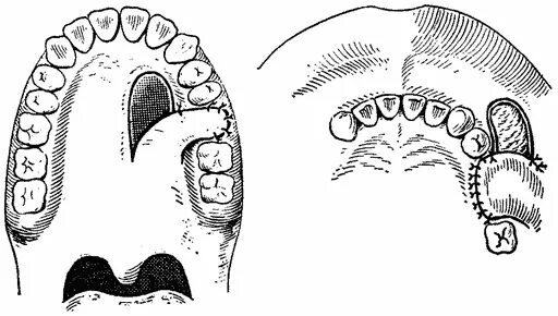 закрытие соустья с гайморовой пазухой. перфорация верхнечелюстной пазухи рентген. трепанопункция лобной пазухи. закрытие гайморовой пазухи. перфорация и свищ верхнечелюстной пазухи.