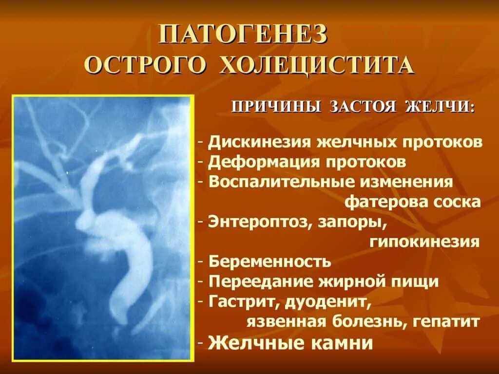 Патогенез острого холецистита. Застойные явления в желчном пузыре.