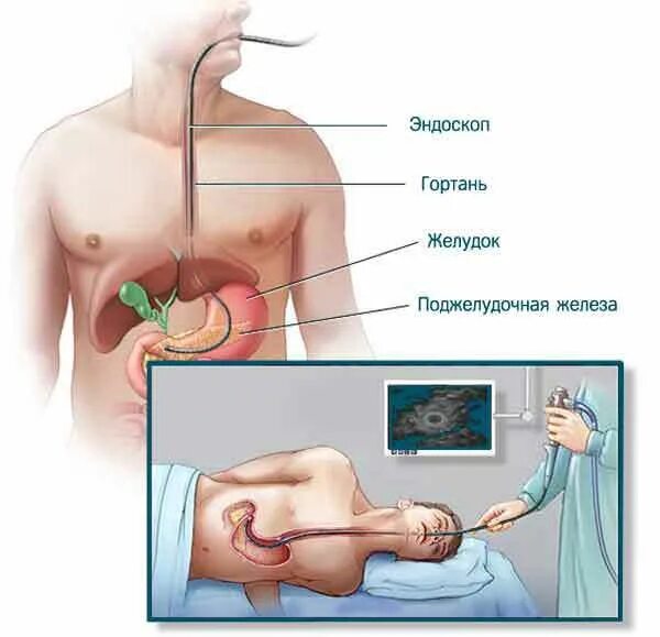 Эндоскопическая биопсия поджелудочной. Эндоскопическая ультрасонография хронический панкреатит. Эндоскопическое ультразвуковое исследование поджелудочной железы. Пункция поджелудочной железы. Эус желудка