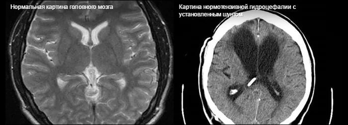 Неокклюзионная гидроцефалия. Синдром Хакима-Адамса нормотензивная гидроцефалия. Нормотензивная гидроцефалия кт. Нормотензивная гидроцефалия головного мозга мрт. Внутренняя гидроцефалия мрт.