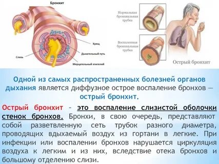Этиология бронхита у детей
