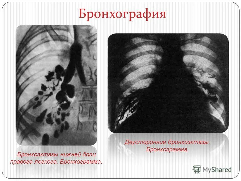 мешотчатые бронхоэктазы это расширение. бронхоэктазы нижней доли легкого. бронхография бронхоэктазы. мешотчатые бронхоэктазы. мешотчатые бронхоэктазы.