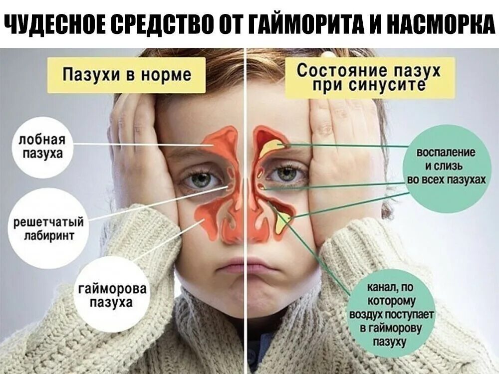 Воспаление носовых пазух. Болит нос и отдает в голову