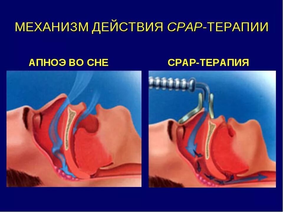 Заболевание апноэ во сне. Сипап аппарат для апноэ сна. CPAP терапия при апноэ. СОАС синдром обструктивного апноэ сна. СРАР аппарат.