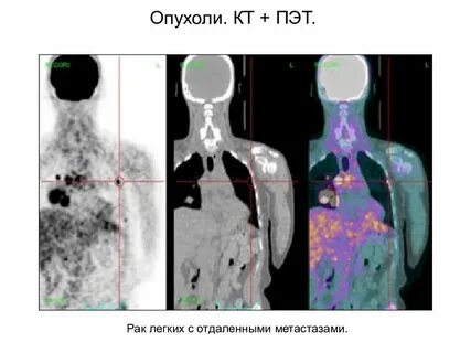 Сколько люди живут с метастазами в легких