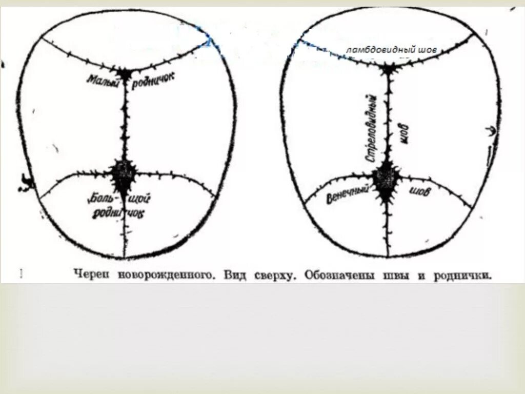 Швы большого родничка. Швы и роднички головки плода. Швы роднички стреловидный шов. Швы головы новорожденного стреловидный. Швы и роднички головки плода Акушерство.