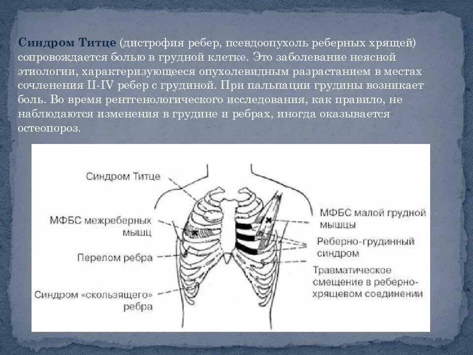 При вдохе болят ребра спереди. Синдром Титце грудная клетка. Синдром Титце хондрит реберный. Болит верхний отдел грудной клетки спереди.