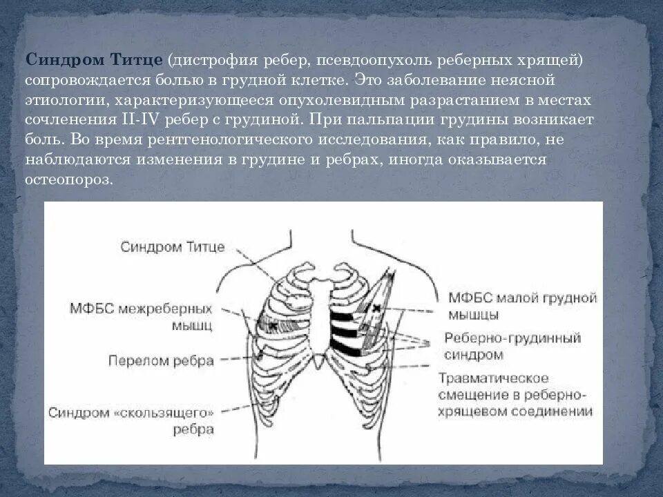 Болит ребро спереди при нажатии. Синдром Титце грудная клетка. Синдром Титце хондрит реберный. Болит верхний отдел грудной клетки спереди.