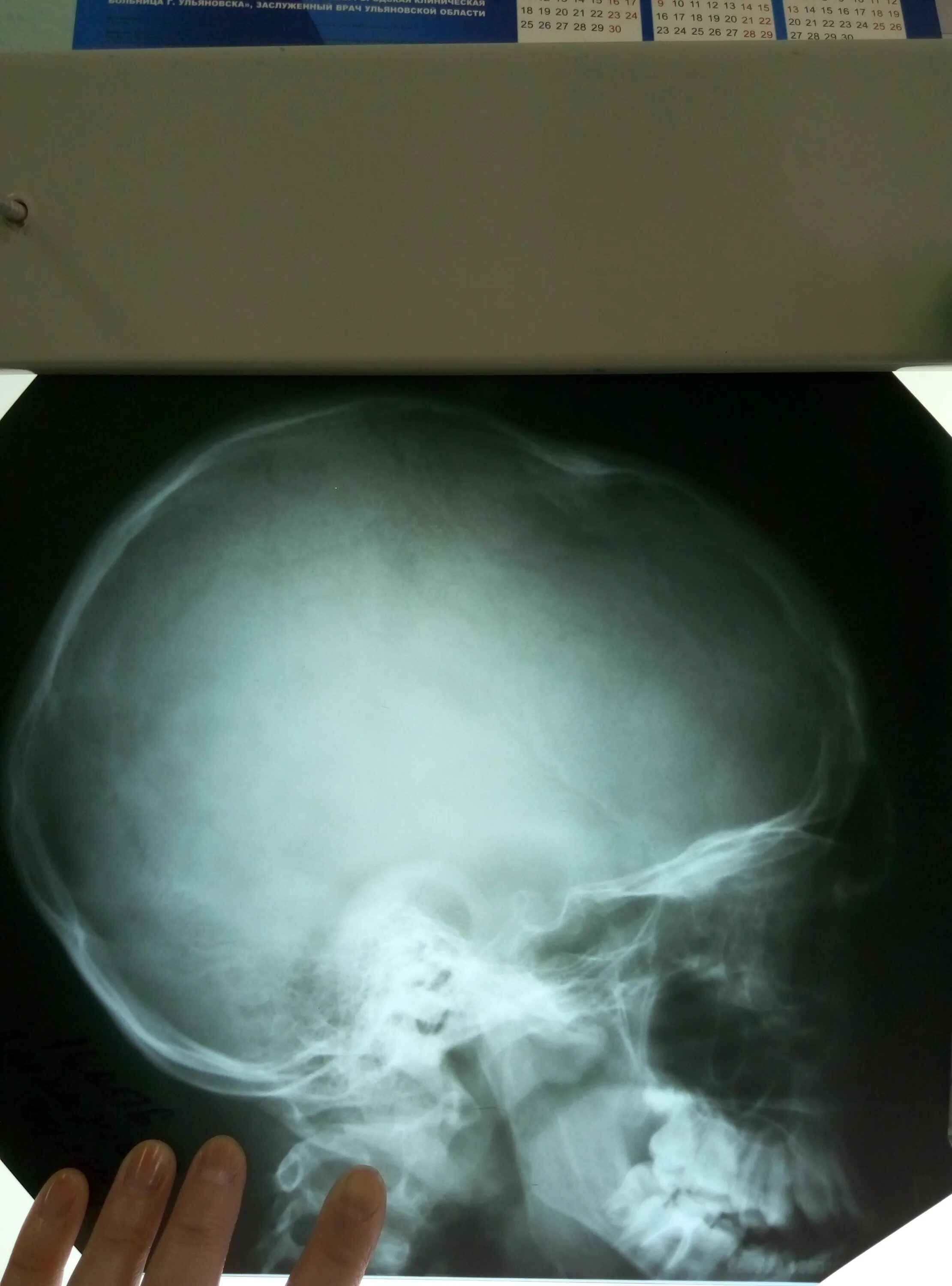 Черепная аномалия. Врожденные аномалии черепа кт. Аномальные черепа у подростков.