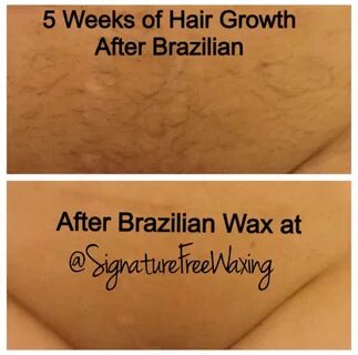 Brazilian Hot Wax Procedure