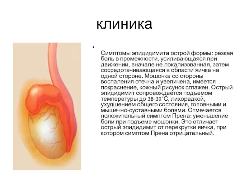 Эпидидимит яичка. Эпидидимит придатка яичка. Острый эпидидимит урология. Гонорейный эпидидимит. Эпидидимит воспаление яичка.