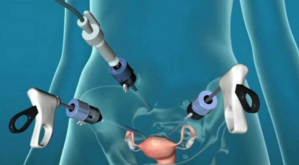 лапароскопия маточных труб. лапароскоп лапароскопия. что такое лапароскопия в гинекологии у женщин. лапароскопия тубэктомия. лапароскопия диагностическая лапароскопия.