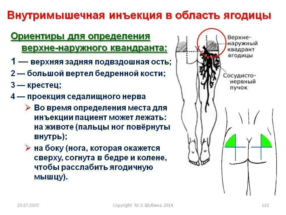 Сильная боль отдает в ягодицу. Схема введения внутримышечных уколов. Схема введения внутримышечной инъекции. Схема укола внутримышечно в ягодицу. Место постановки укола в ягодицу.