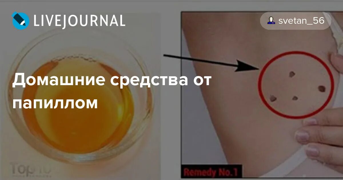 Как пользоваться чистотелом от папиллом. Нитевидные бородавки (акрохорды). нитевидная папиллома на лице. как выглядят нитевидные папилломы.