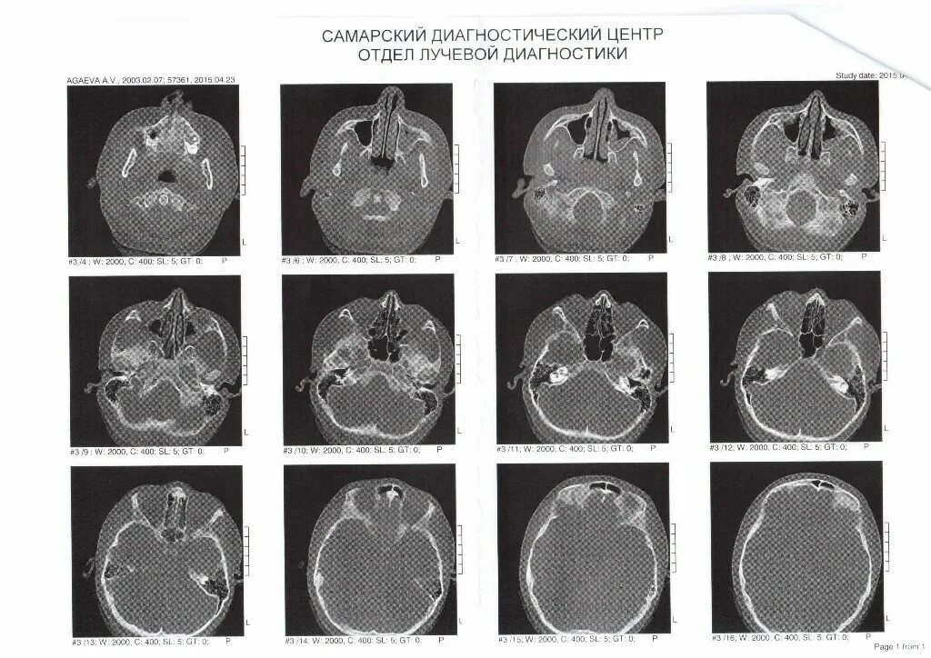 Сфеноидит операция. Хронический сфеноидит на кт. Кт признаки сфеноидита. Хронический сфеноидит мрт. Сфеноидит МСКТ.