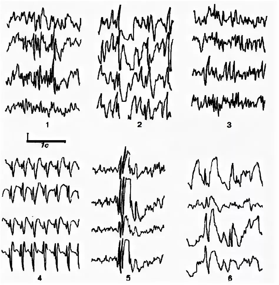 Медленные волны на ээг. Спайк волна на ЭЭГ. ЭЭГ эпилепсия острая медленная волна. Пик медленная волна на ЭЭГ что это. Комплекс острая волна медленная волна на ЭЭГ.