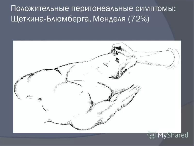 Аппендицит блюмберга симптомы. Синдром щеткина -блюмберга это. перитонит симптом щеткина блюмберга. симптом менделя и щеткина-блюмберга. положительный симптом щеткина-блюмберга.