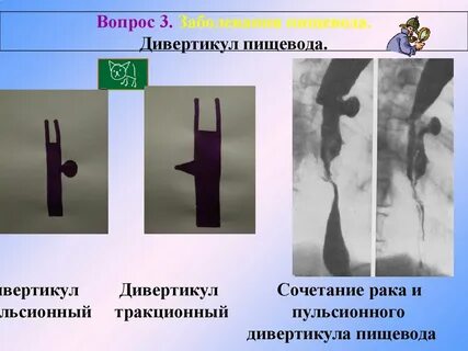 Дивертикул пищевода