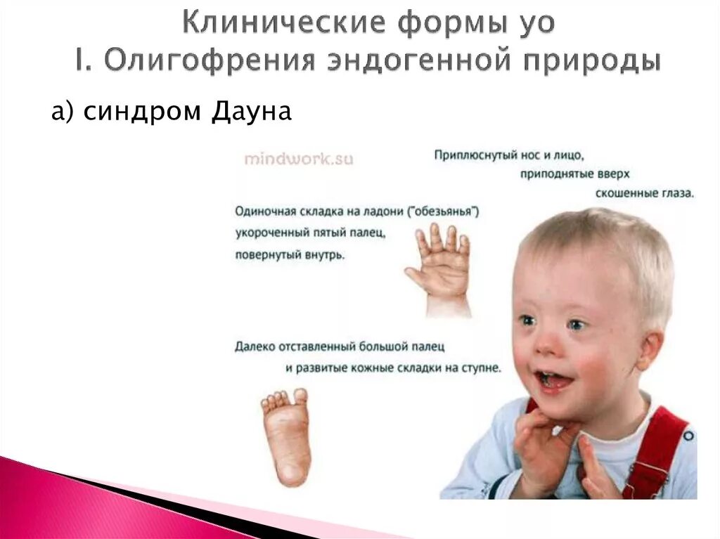 Синдром умственной отсталости. Синдром умственной отсталости