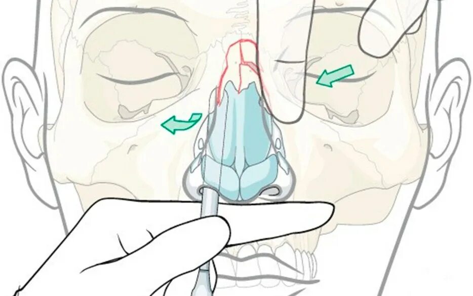 Можно вправить нос. Перелом костей носа репозиция. Пальце инструментальная репозиция костей носа. Закрытая репозиция костей носа.
