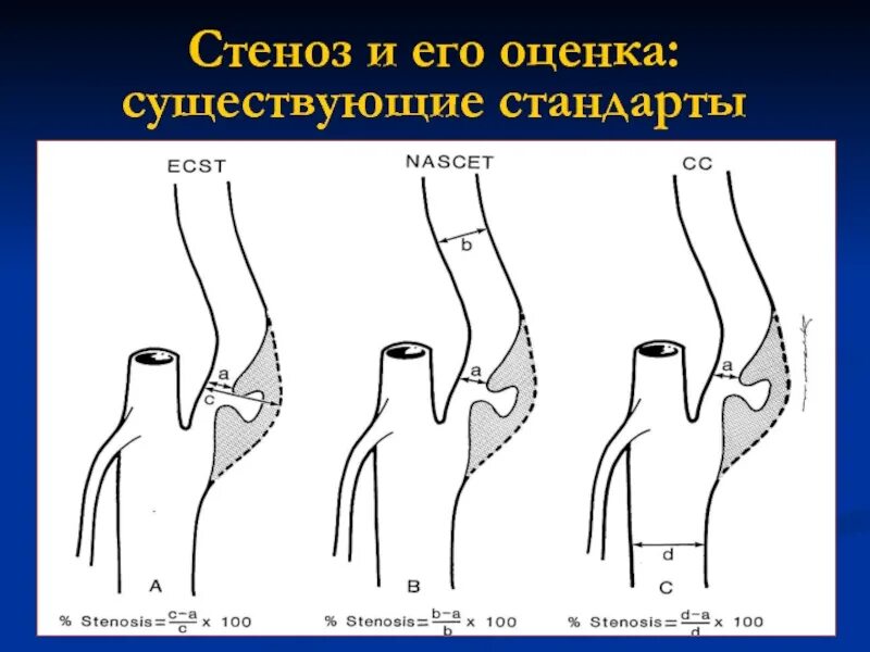 Процент стеноза сосудов. Измерение стеноза по nascet. Степени стеноза ВСА по nascet. Степень стеноза артерий по nascet. Классификация стенозов сонных артерий.