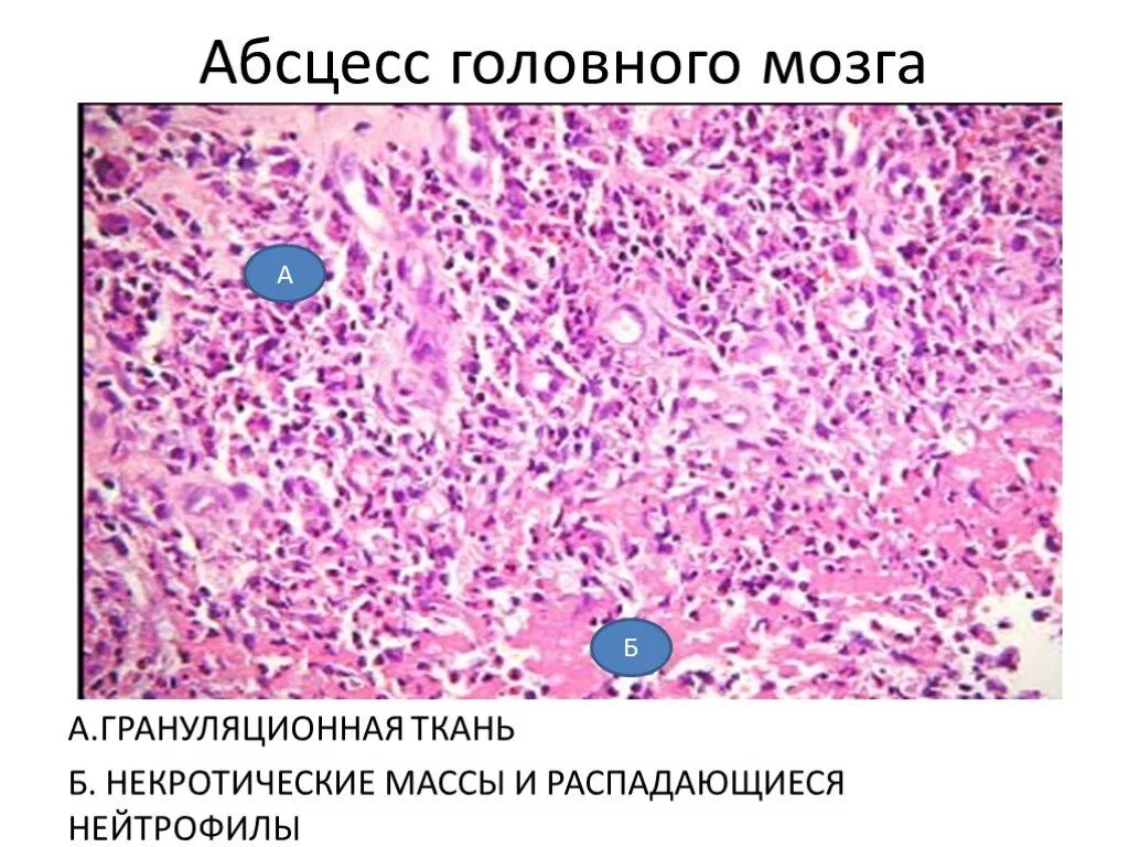 Микропрепарат головного мозга. Абсцесс головного мозга микропрепарат описание. Абсцесс головного мозга патанатомия. Грануляционная ткань гистология. Эмболический Гнойный нефрит микропрепарат.