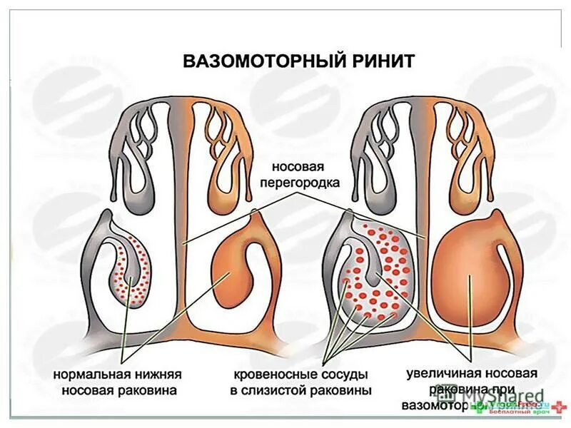 Подслизистой вазотомии нижних раковин. Вазомоторный ринит эндоскопия. Слизистая носа вазомоторный ринит. Вазомоторный ринит риноскопия. Вазомоторный ринит скорью.