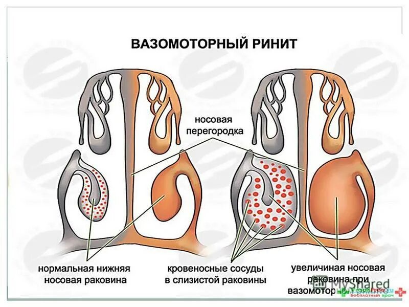 Вазомоторный ринит лечение народными средствами. Вазомоторный ринит лечение народными средствами