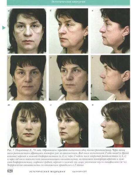 эндоскопический лифтинг средней зоны лица. мошак надежда анатольевна. доктор мошак владивосток. пластическая хирургия владивосток. пластическая хирургия владивосток.