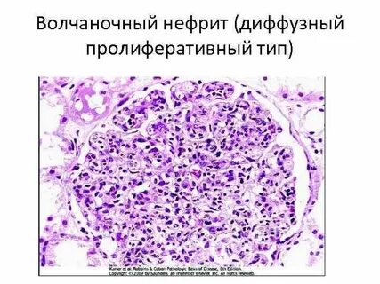 Диффузный нефрит